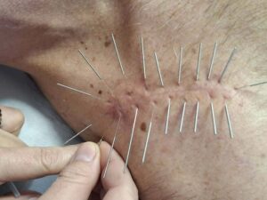 leczenie-blizn-lodz-4